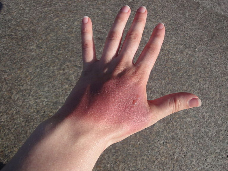 Safety tips for July 4th Preventing firework burns