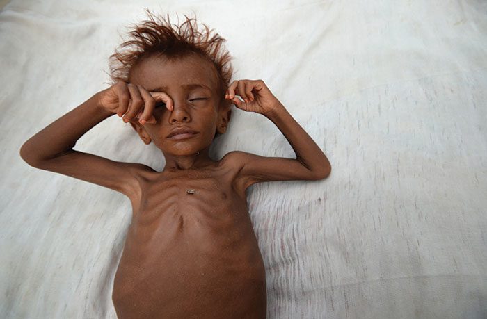 The war in Yemen must end, as famine spreads