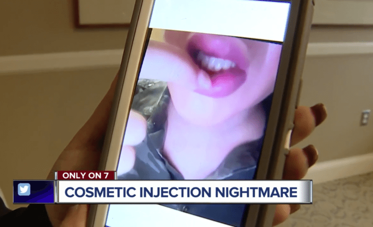 Woman’s lips injected with non-FDA approved product at Dearborn Heights salon