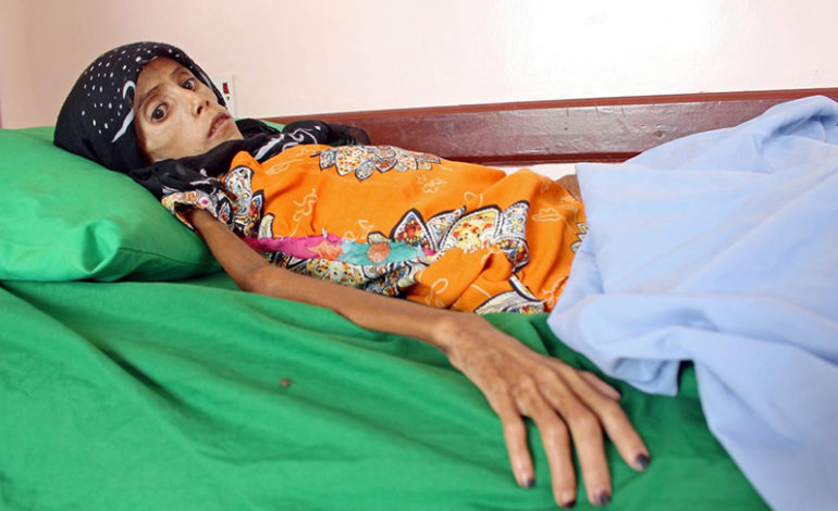 Starving girl shows impact of Yemen war, economic collapse