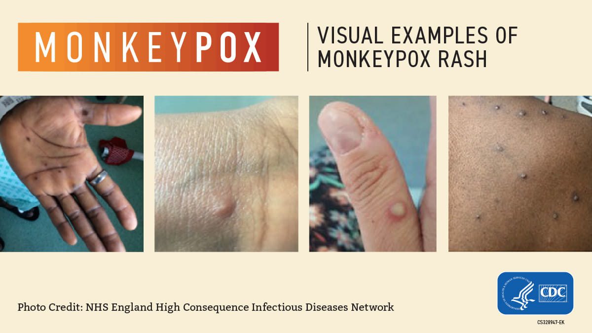 Visual guide for monkeypox infections